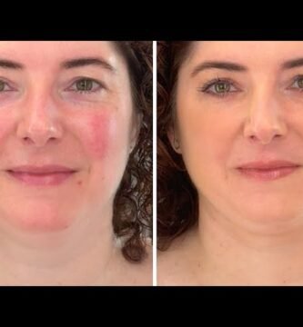 cómo aplicar maquillaje para piel con rosácea