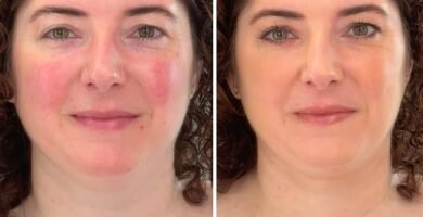 cómo aplicar maquillaje para piel con rosácea