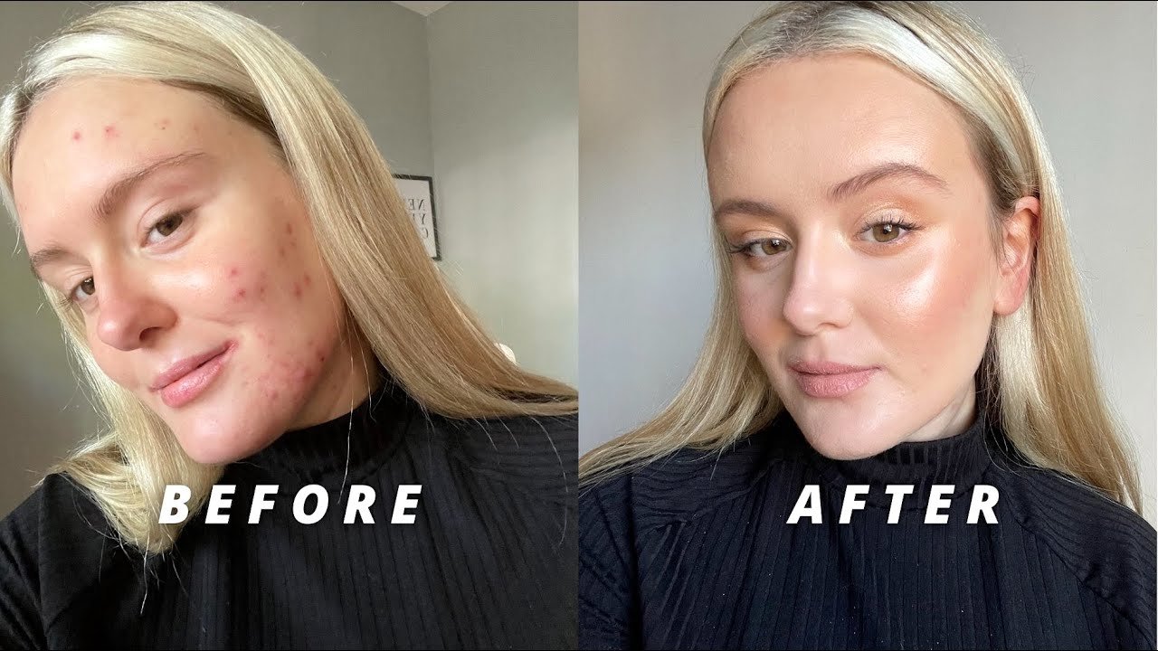 cómo lograr un look natural con maquillaje para piel con acné